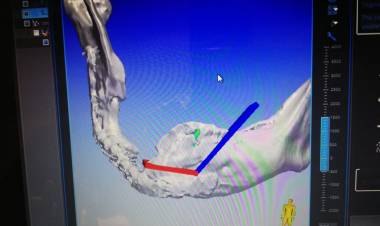 PRIMERA CIRUGÍA ASISTIDA POR COMPUTADORA EN UN HOSPITAL PÚBLICO DE SAN LUIS