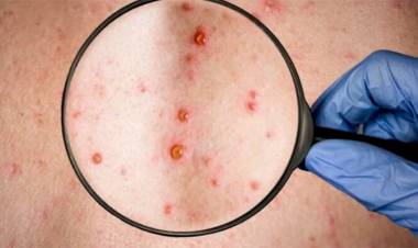 SALUD DE LA NACIÓN EVALÚA UN SEGUNDO CASO SOSPECHOSO DE VIRUELA DEL MONO EN EL PAÍS